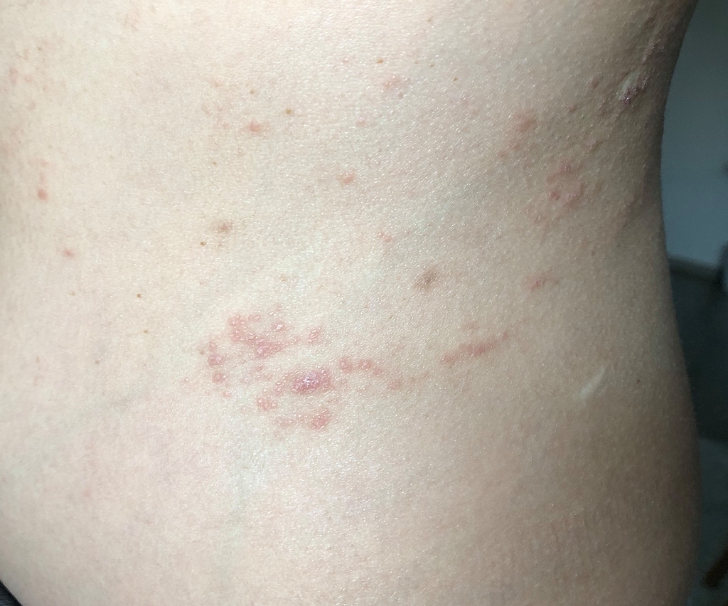 the-eczema-first-appeared-in-june-2019-on-the-abdomen-dermatology