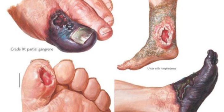 Diabetic Foot Ulcers: Practice Essentials, Cause ...