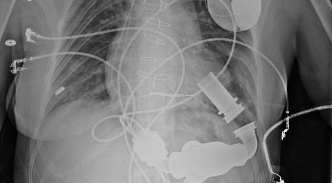 Case Study: Treatment Of Postpartum Cardiomyopathy With LVAD And Heart ...