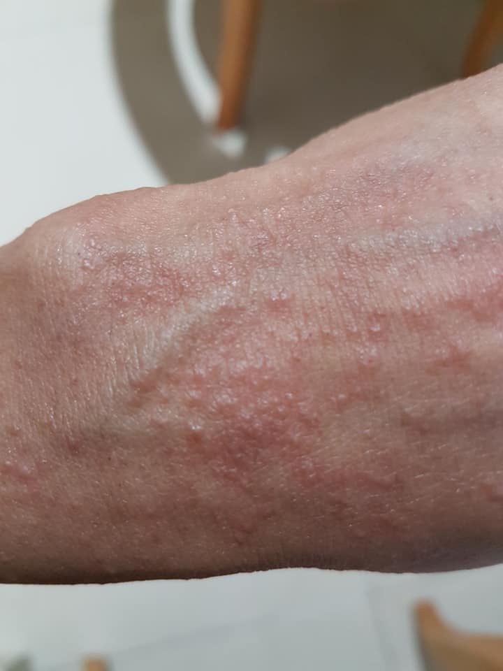 How The Raised Itchy Bumps Are Caused In The Skin Tiny Itchy Bumps My