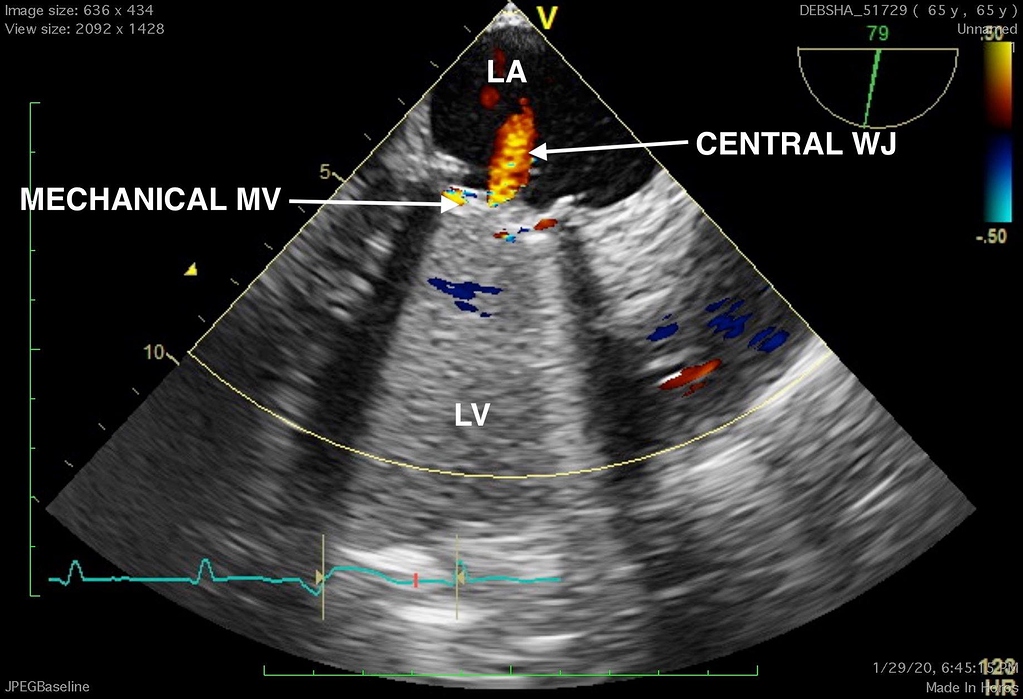 medtronic-hall-prosthetic-mechanical-mitral-valve-cardiology-www