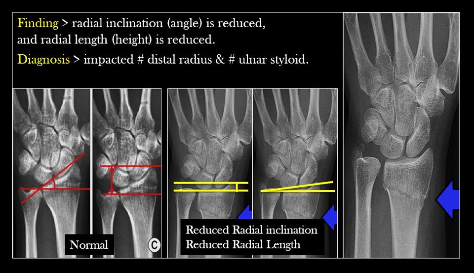 Plain X-ray of the Wrist (PA view) Part 4 - Radiology - www.MedicalTalk ...