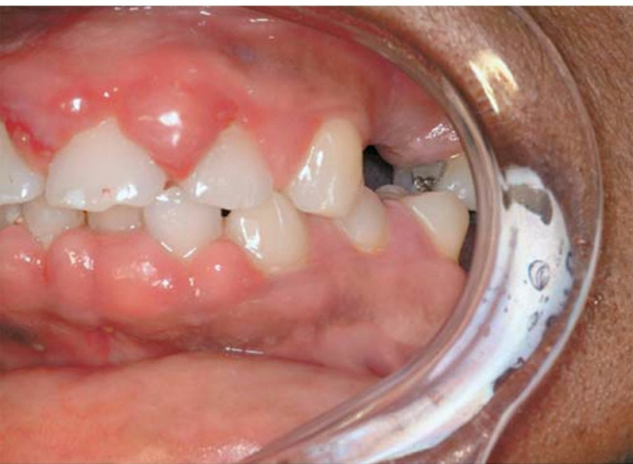 which-anti-hypertensive-drug-can-cause-following-gum-hypertrophy-neet