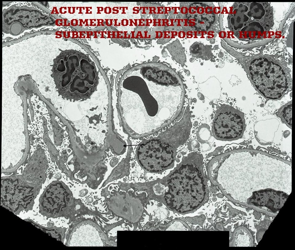 Acute Post Streptococcal Glomerulonephritis - NEET PG - Www.MedicalTalk ...