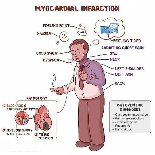 The myocardial infarction - Memes - www.MedicalTalk.Net the Best ...