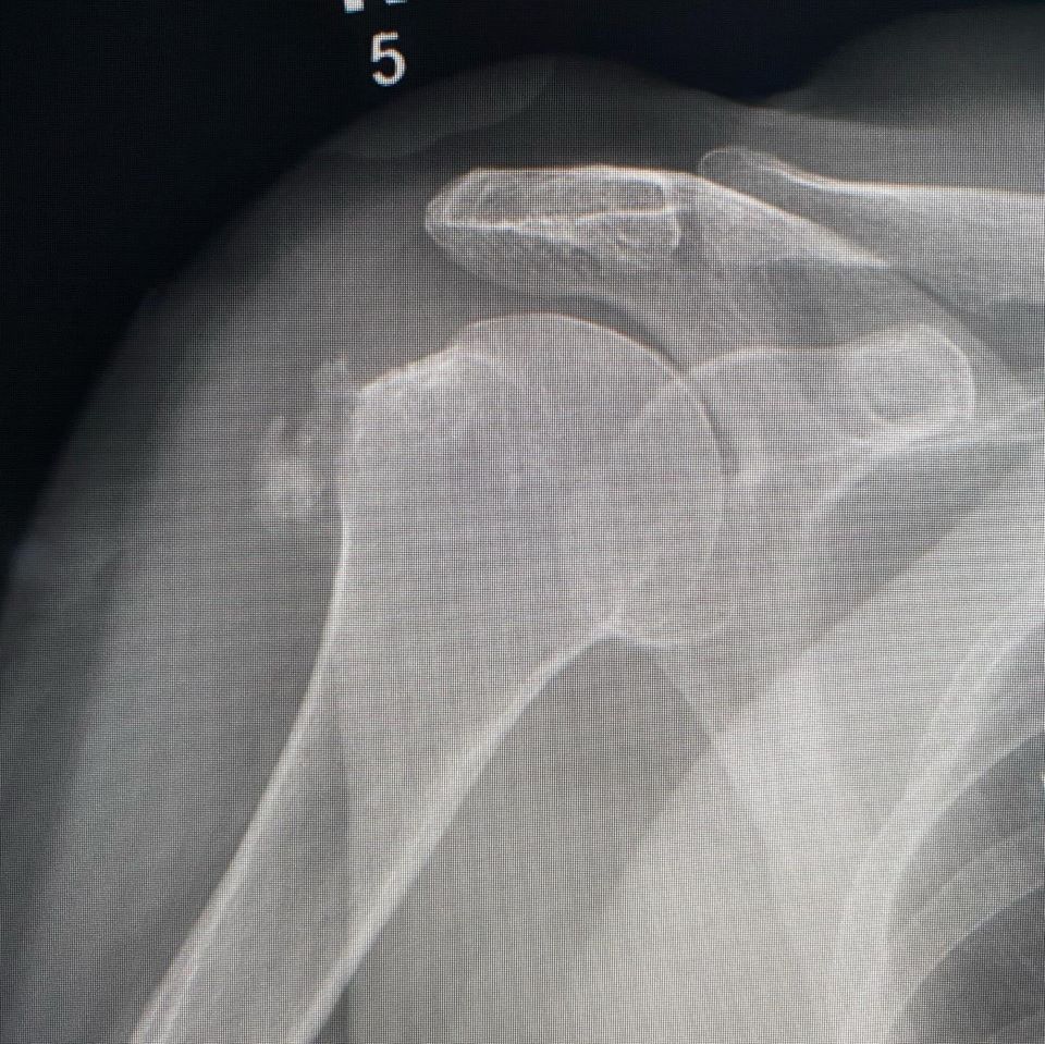 Calcific Bursitis! Hydroxyapatite deposition disease - Radiology - www ...