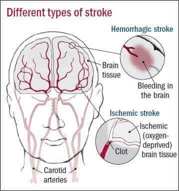 Stroke 3. Тиа инсульт. Stroke Symptoms. Ischemic stroke in Medicine.