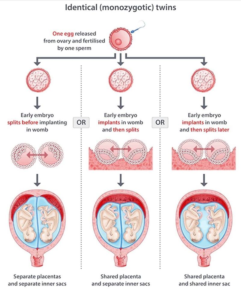 Identical twins monozygotic - NEET PG - www.MedicalTalk.Net the Best ...