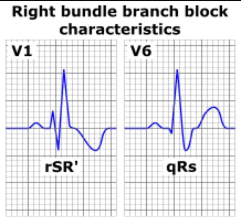 Right Bundle Branch Block (RBBB): - cardiology - www.MedicalTalk.Net ...