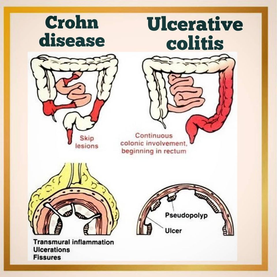 Crohn Disease Ulcerative Colitis - Memes - Www.MedicalTalk.Net The Best ...