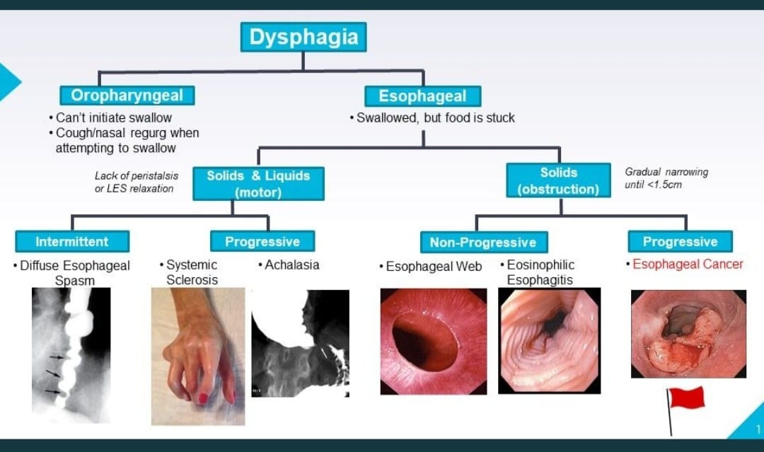 Approach To Dysphagia - NEET PG - Www.MedicalTalk.Net The Best Medical ...